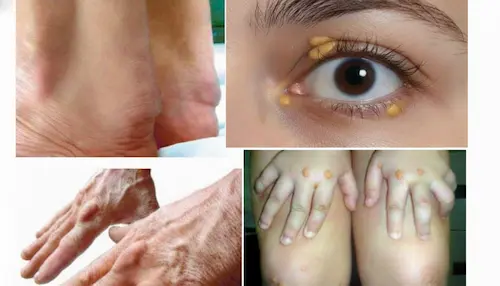 Signos clínicos de hipercolesterolemia familiar en ojos y tendones